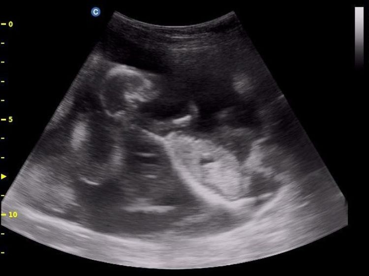 black and white photo of ultrasound image